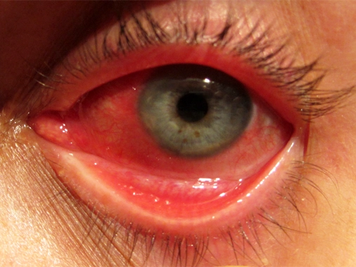 Allergic Conjunctivitis