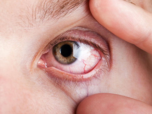 Dry Eye Treatment Izmir