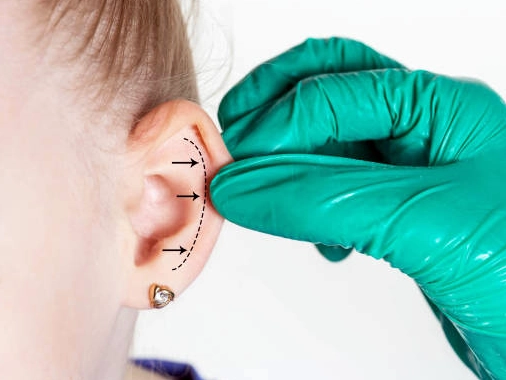 Kepçe Kulak Ameliyatı (Otoplasti) İzmir