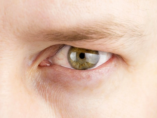 Treatment of Eyelid Drooping (Ptosis) in Turkey