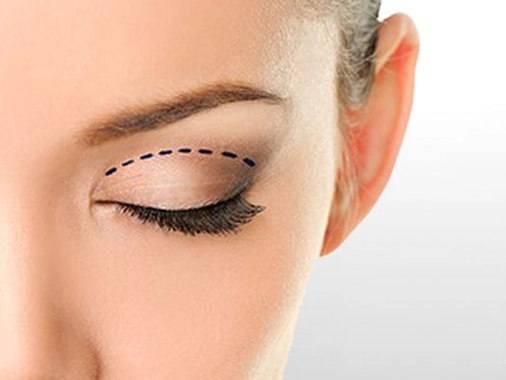 Who is a Candidate for Eyelid Surgery?